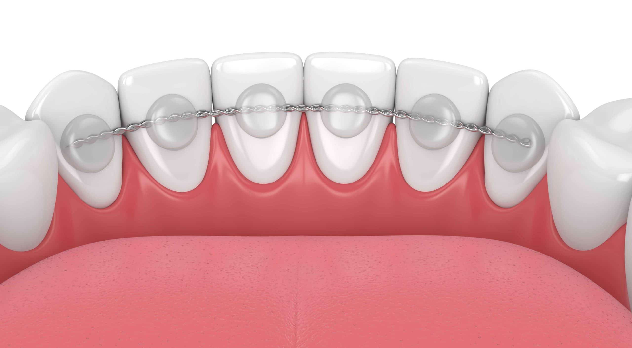 A diagram of a bonded retainer behind the lower teeth.