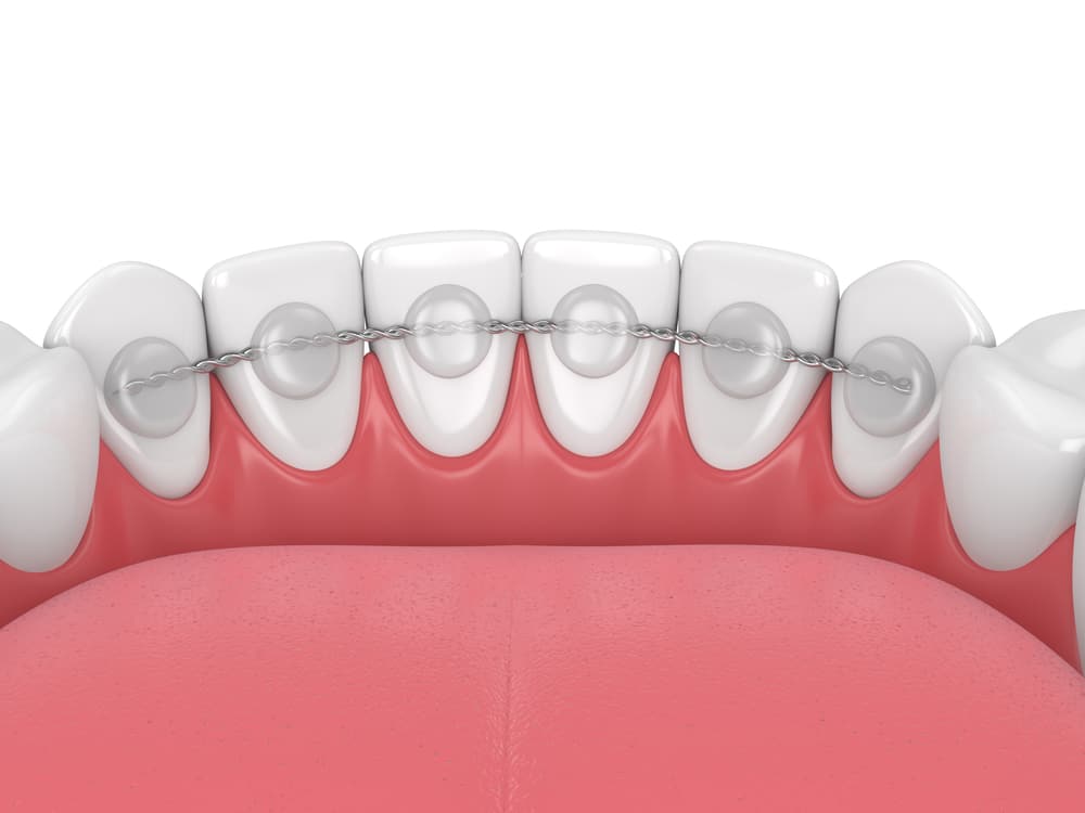 3d image of a permanent retainer. A braided wire bonded behind the bottom teeth.